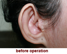plastic-surgery-prominent-ear 